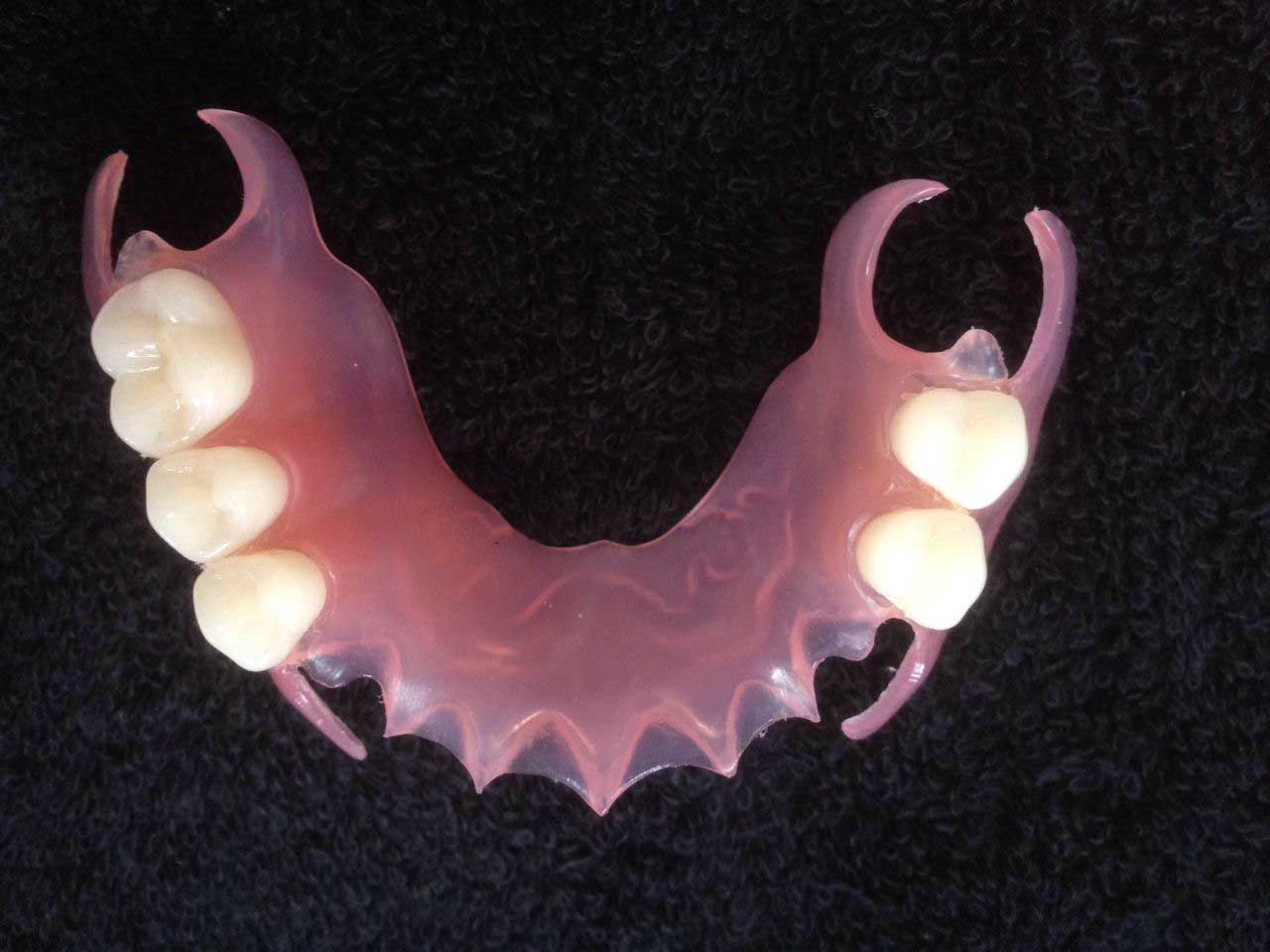 Delna zobna proteza Dental Akrilni zobje v zobozdravstvu hitro in enostavno