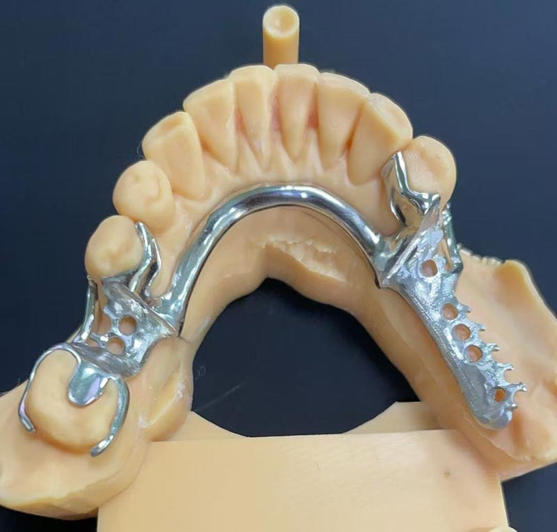 Prednosti kobalt-kromovega okvirja (Co Cr okvir)