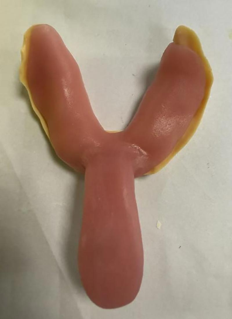 Stvari, ki jih niste vedeli o zobnih pladnjih po meri