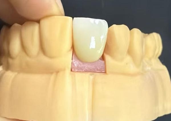 Vrzeli med zobmi je mogoče popraviti - ravni zobje so najbolj privlačni!