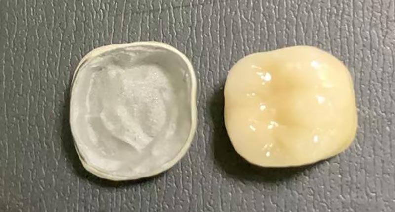 Kaj storiti, ko se vaša porcelanasta krona drobi? Evo, zakaj se to zgodi in kako to popraviti