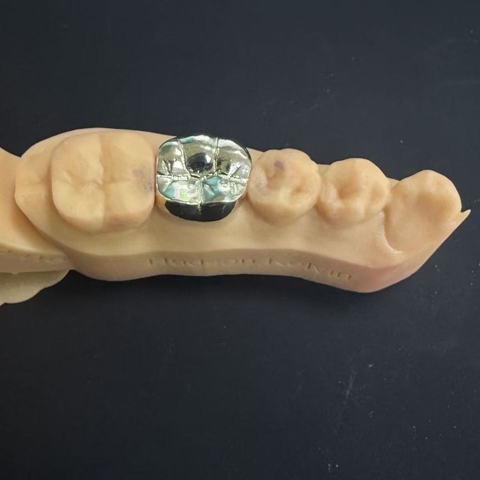 Zlate krone: izbira plemenite kovine za vseživljenjsko obnovo zob