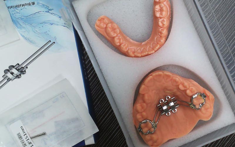 Razumejte širjenje skeleta MSE z WM Dental Lab