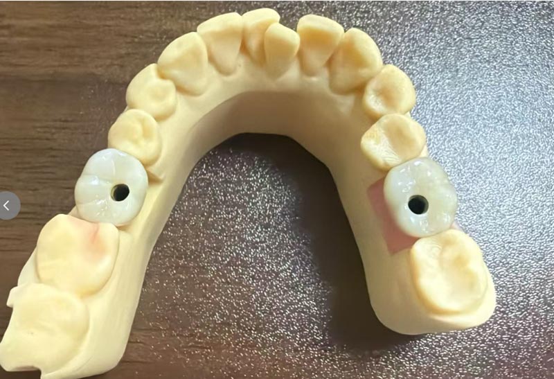 Zakaj je implantacija sprednjega zoba težja od implantacije zadnjega zoba?