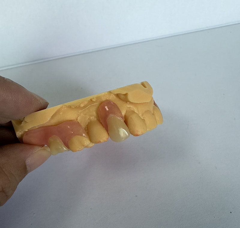 Valplast Partials v WM Dental Lab