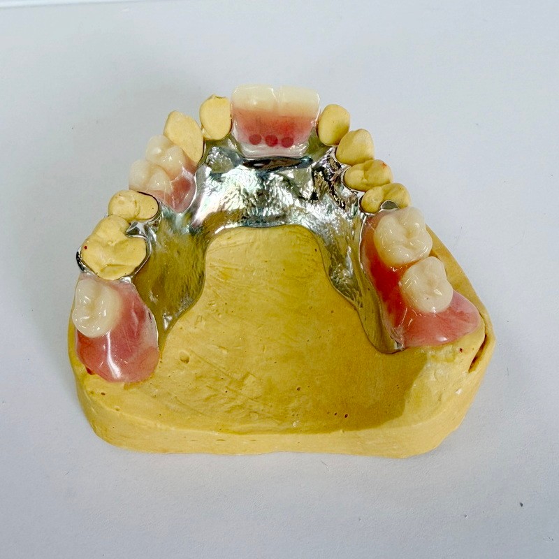 Odstranljivo obnovitveno delno ogrodje